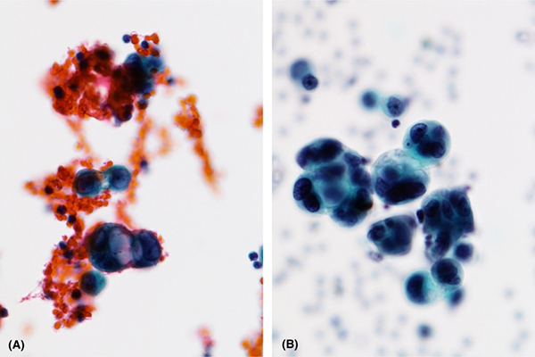 Liquid-Based Cytology: The “Microscopic Revolution” in Early Cancer Screening