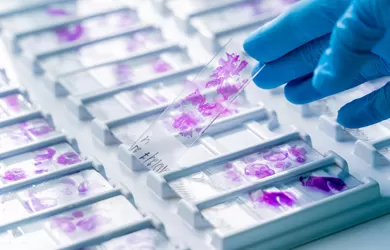 Cervical Liquid Based Cytology