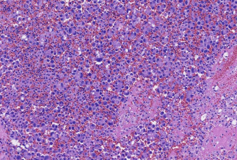 Pleural effusion HE ×20