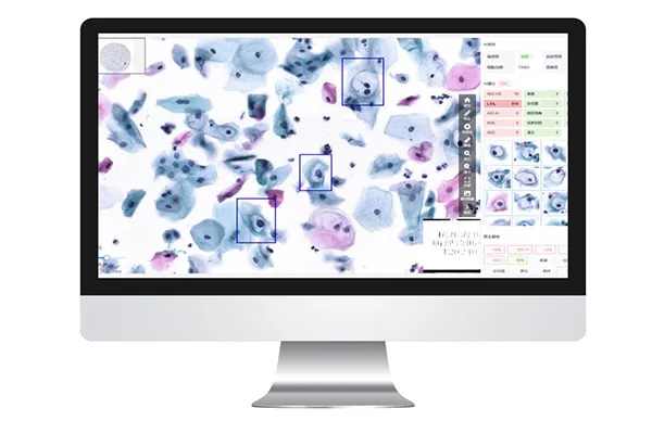 How Integrating AI with Liquid-Based Cytology (LBC) Redefines Cervical Screening