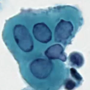 Herpes Simplex Virus（HSV）