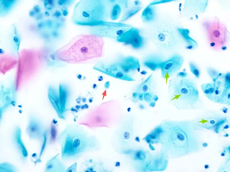 Trichomonas-vaginalis.jpg Trichomonas-vaginalis.jpg